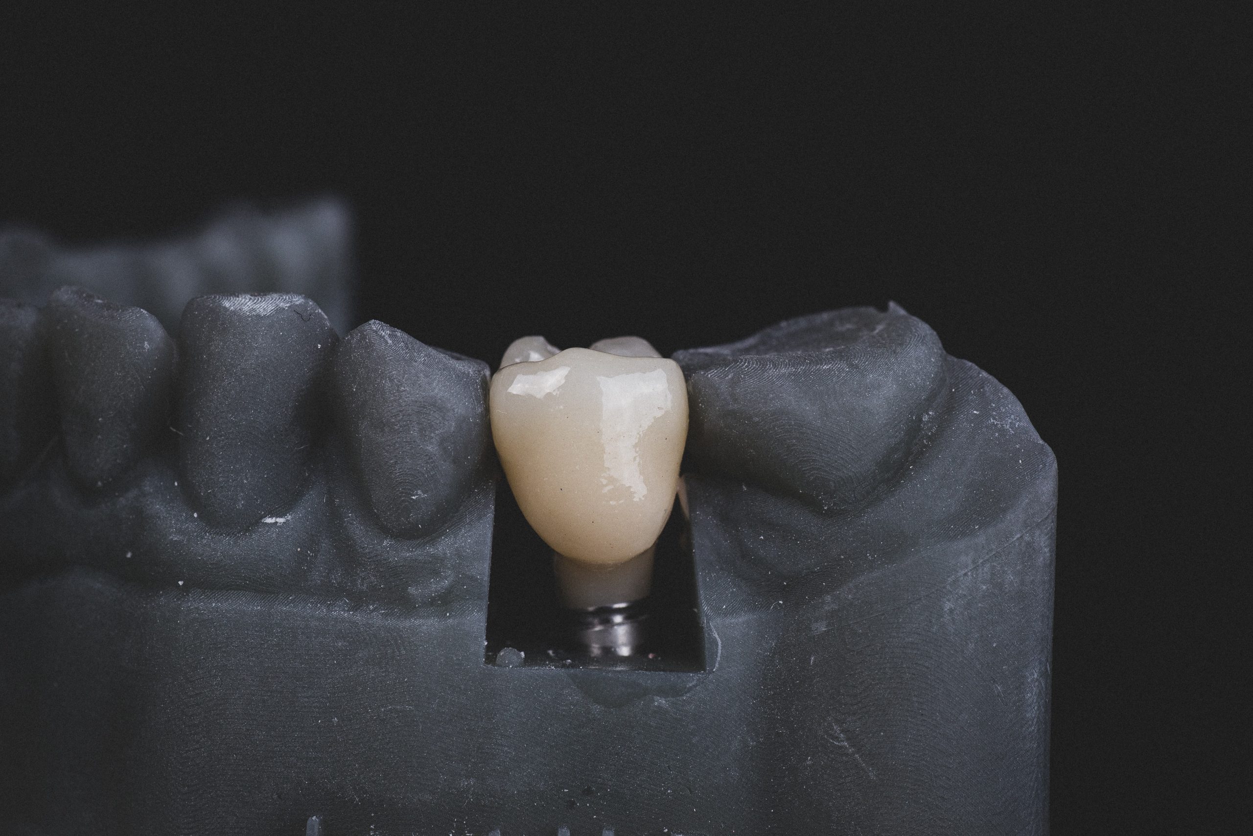 Why Dental Implants Are the Best Solution for Missing Teeth: A Comprehensive Guide from Orchid Dental Care