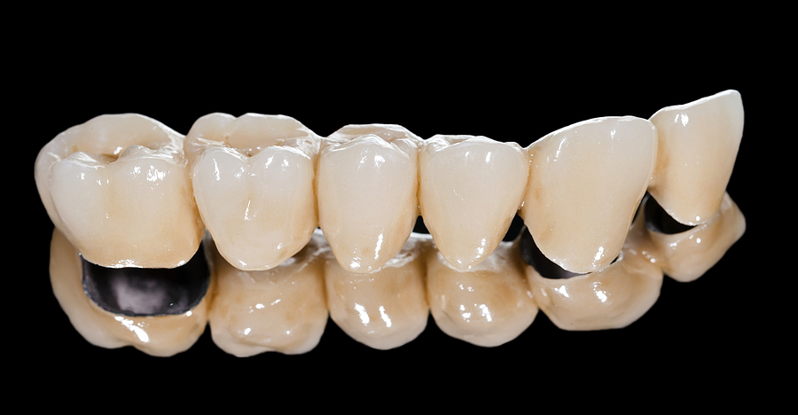 A Complete Guide to Dental Bridges: Restoring Your Smile with Confidence