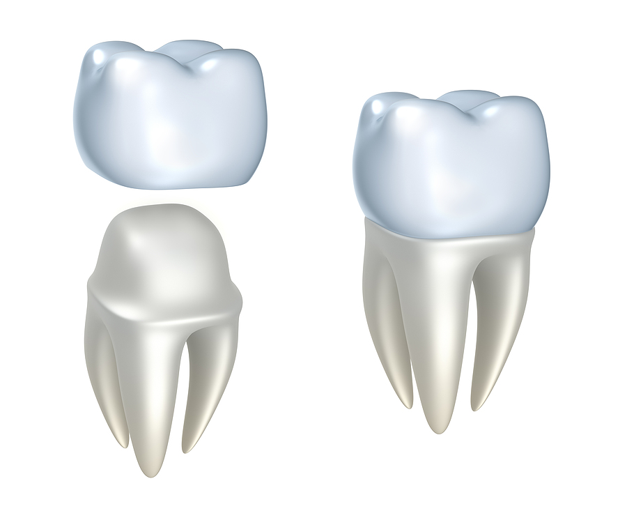 Understanding Dental Crowns: A Complete Guide to Restoring Your Smile