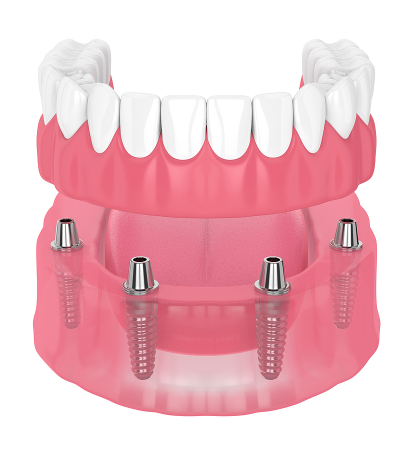 Implant Retained Dentures: A Secure Solution for Tooth Loss